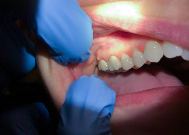 Best Emergency Care for Gum Disease in Paulsboro, NJ